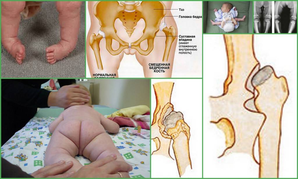 Дисплазия тазобедренных суставов у детей - симптомы, степени, лечение, фото - «медикидс»