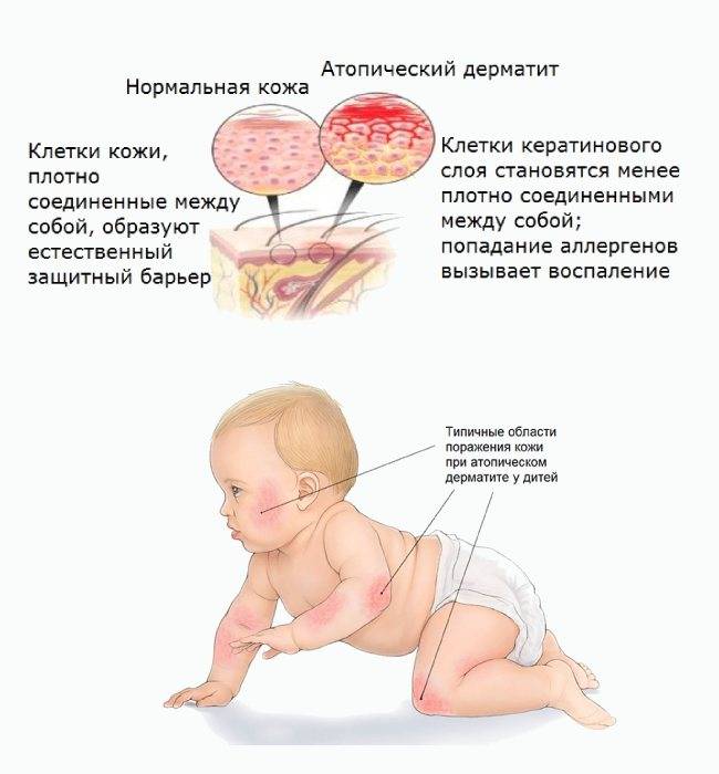 Потница у новорожденных: причины, симптомы, лечение