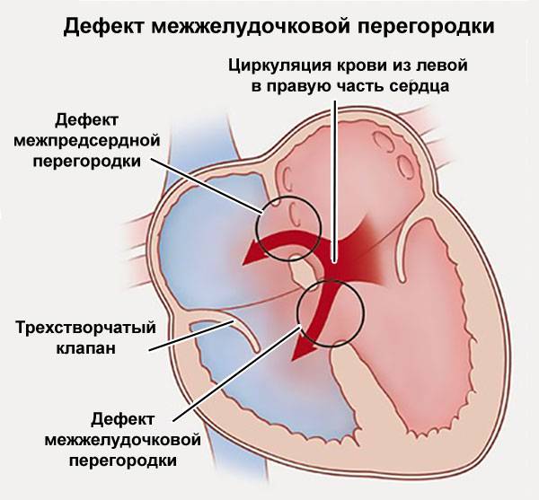 Дефект межжелудочковой перегородки у детей фото