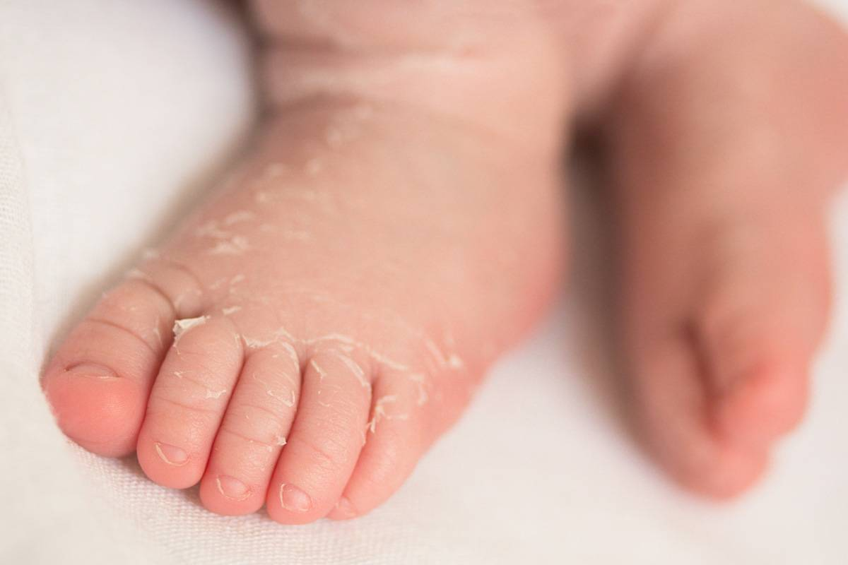 Почему у новорожденных шелушится кожа и как с этим бороться