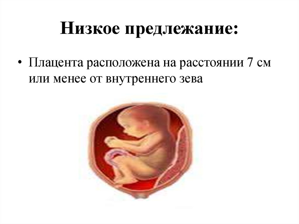 Низкая плацентация при беременности – что это значит? чем опасна низкая плацентация для ребенка и протекания беременности? - автор екатерина данилова - журнал женское мнение