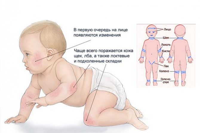 9 методов лечения экземы у ребёнка от детского аллерголога