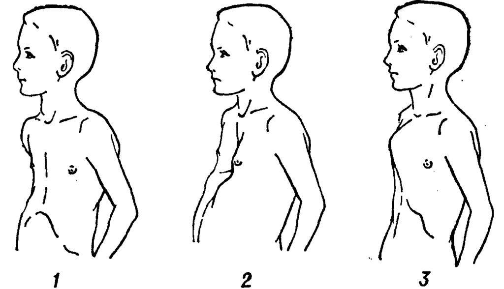 Как исправить грудную клетку. Килевидная грудная клетка у ребенка. Килевидная форма деформации грудной клетки. Синдром Марфана деформация грудной клетки. Килевидная форма грудной клетки у новорожденного.