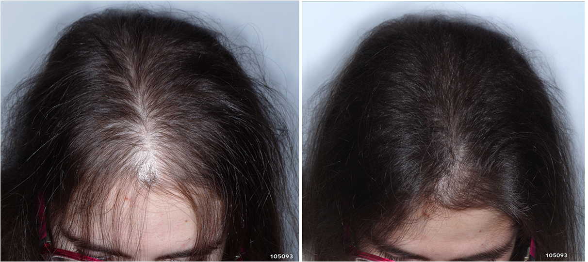 Могут ли выпадать волосы при приеме мидианы