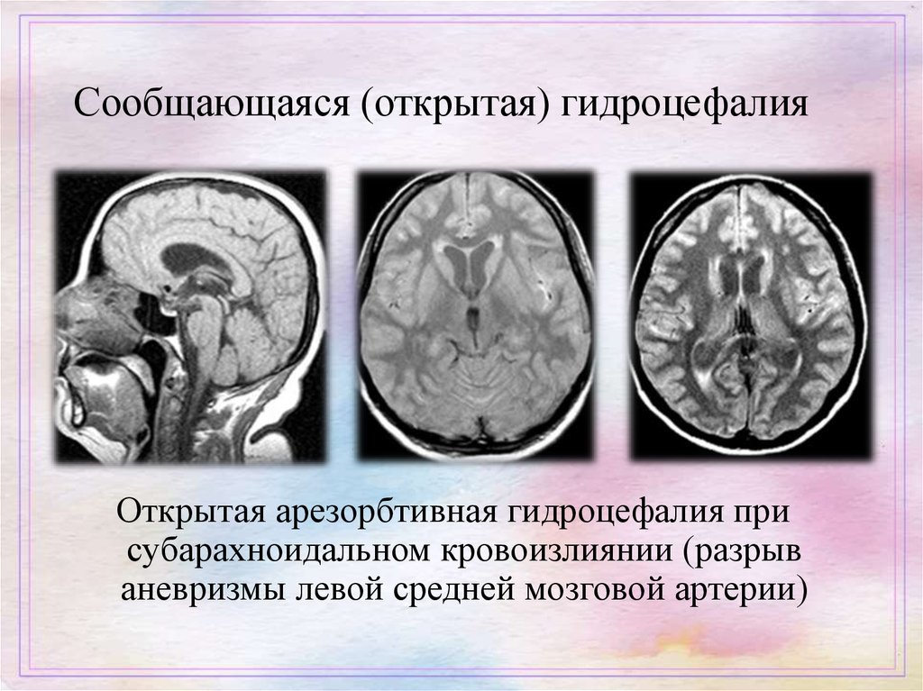 Гидроцефалия головного мозга на мрт