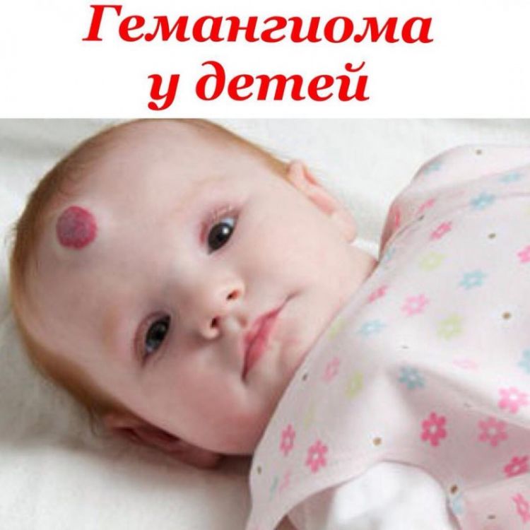 Гемангиома у новорожденных – причины возникновения и методы лечения