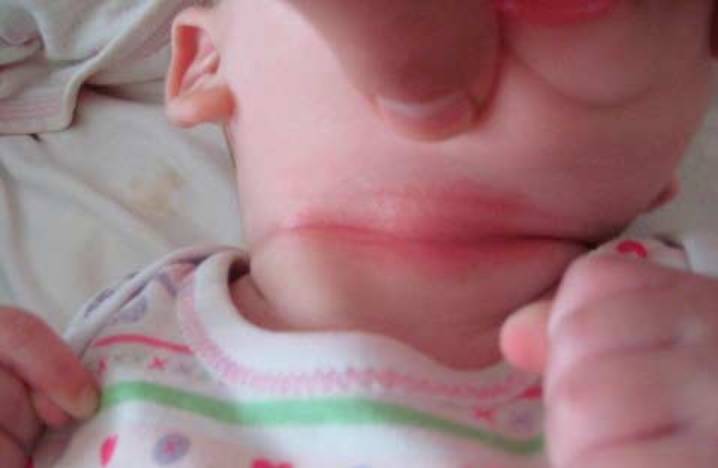 Опрелости на шее у новорожденных: чем лечить, чем мазать | мокнет шея у грудничка
