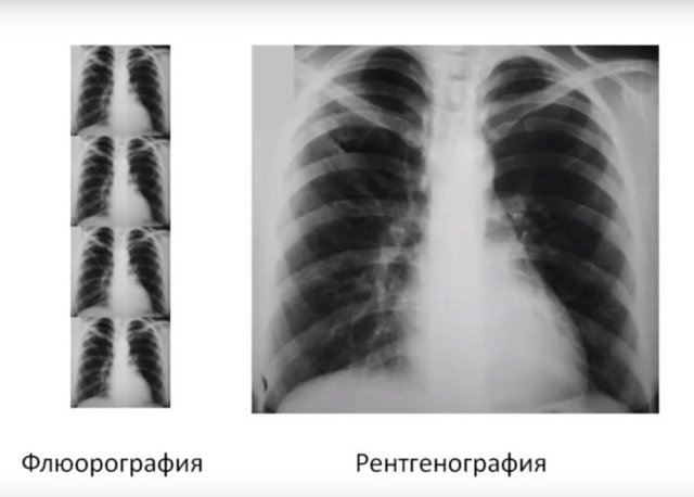 Флюорография при грудном вскармливании, можно ли делать кормящей матери?