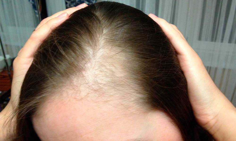 Почему сильно выпадают волосы и что с этим делать