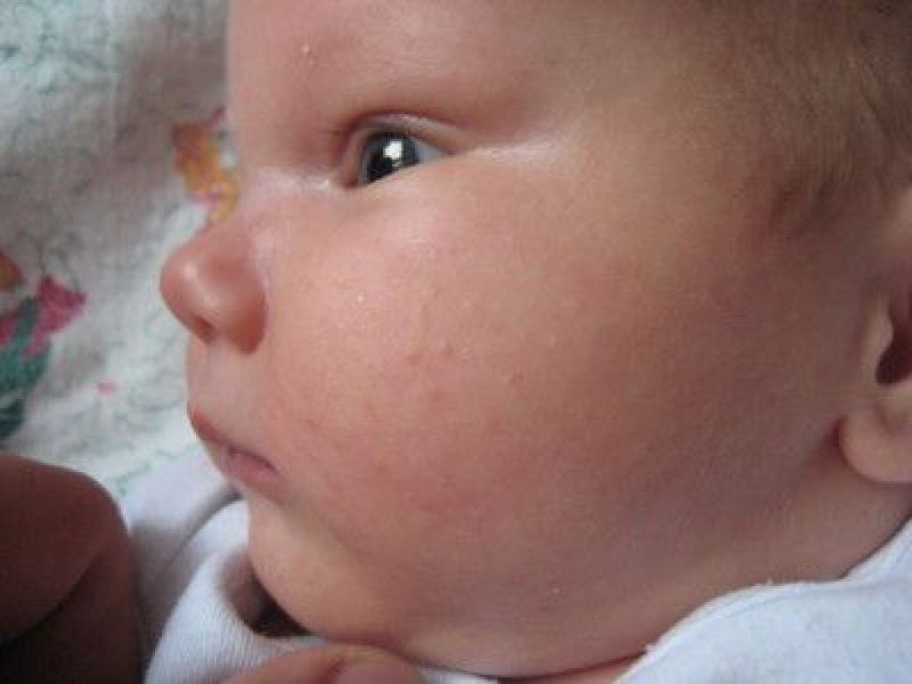 Красные прыщики на лице у новорожденного: симптомы, причины и лечение | mustela