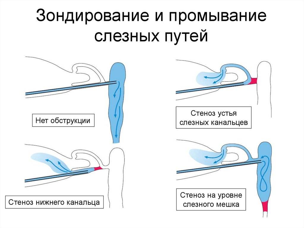 Зондирование слезного канала: показания к проведению процедуры, последствия, отзывы :: syl.ru