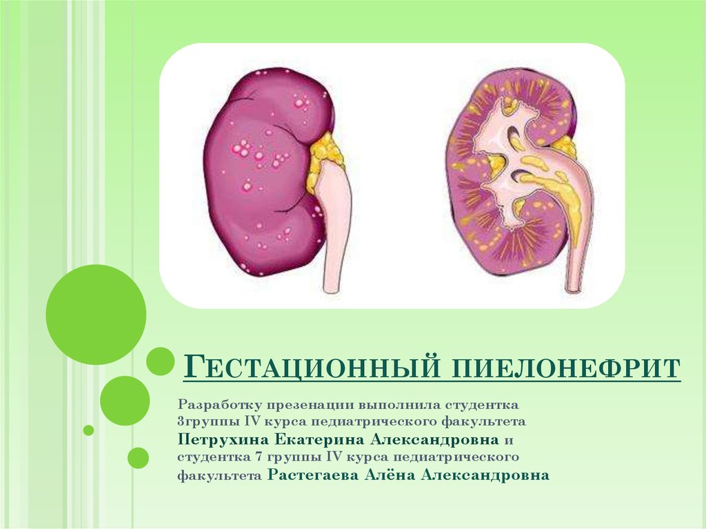 Пиелонефрит у беременных презентация