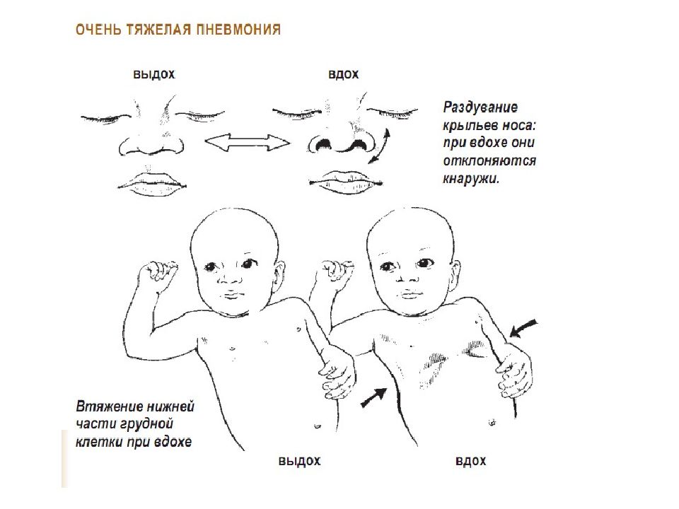 аспирационный синдром у новорожденных