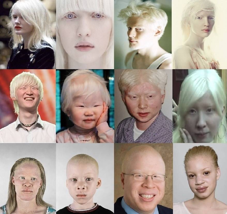 Альбинизм. причины, симптомы и лечение!