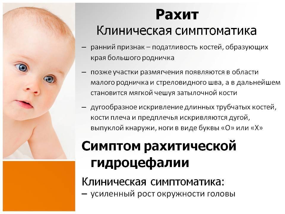 Профилактика рахита у детей до года и после. лечение рахита у новорожденных и грудничков.