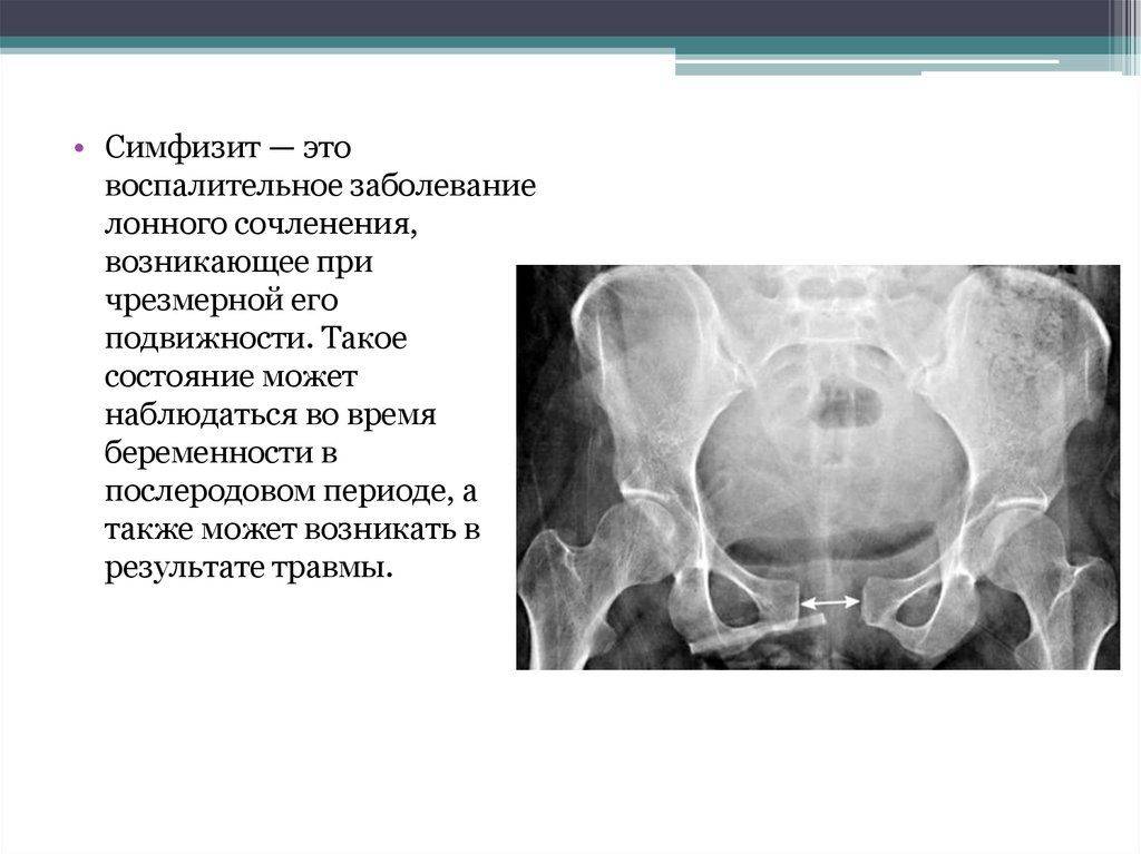 Симфизит. расхождение тазовых костей во время беременности