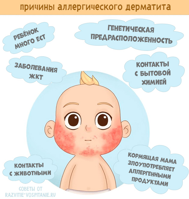 Диатез у детей: симптомы, фото, лечение и профилактика
