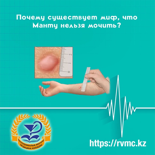 Проба манту: почему нельзя мочить, оценка результата