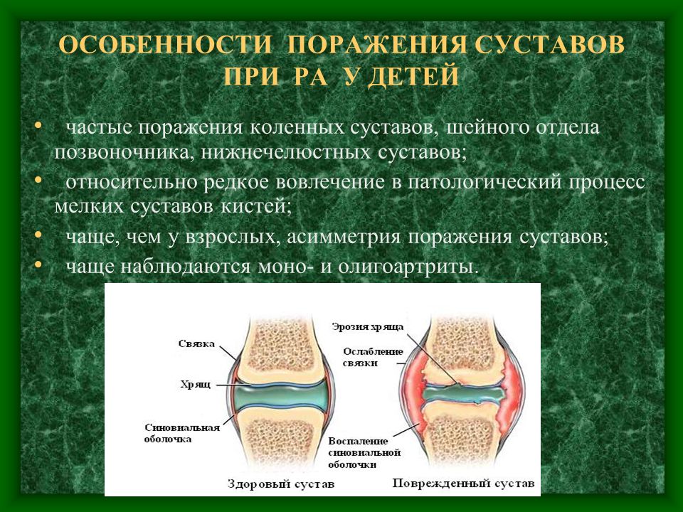 Ювенильный ревматоидный артрит