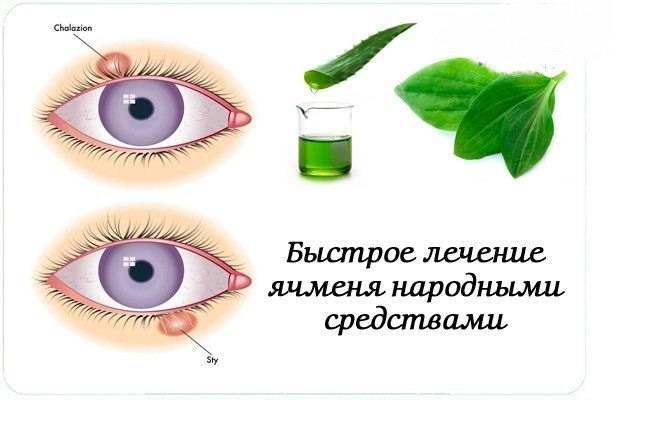 Глаз ячмень чем лечить в домашних условиях. Этапы развития ячменя на глазу.