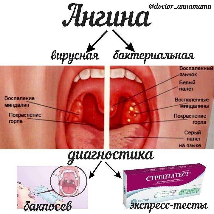 Ангина. лечение и симптомы ангины. виды ангин. возможные осложнения при ангине.