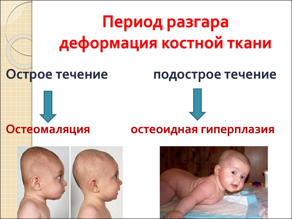 Рахит у грудничков (новорожденных): 10 признаков, 9 причин, симптомы, лечение, профилактика