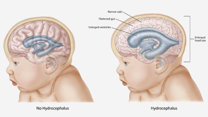 Псевдокиста головного мозга у новорожденных детей: причины и методы лечения