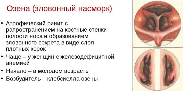 Симптомы и лечение вазомоторного ринита у детей