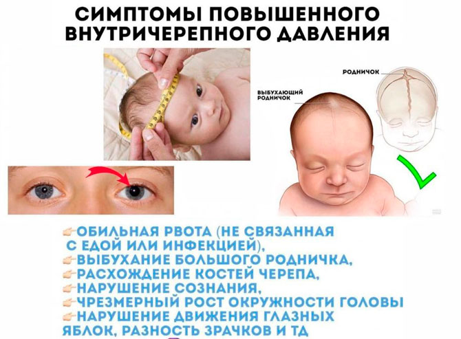 Синдром грефе у новорожденных фото