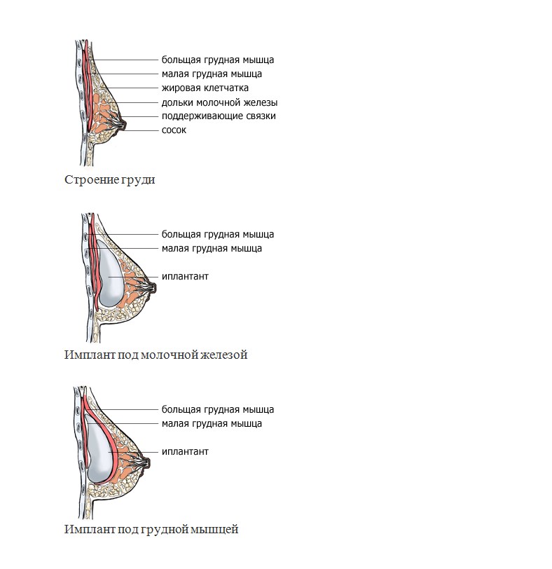 Маммопластика: увеличение груди – все об увеличении грудных желез | клиники «евроонко»