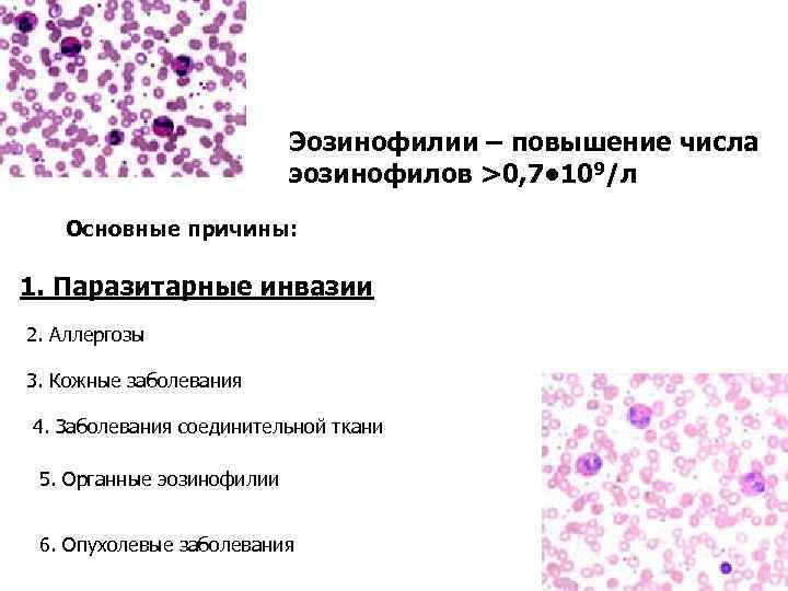 Эозинофилы в крови 0