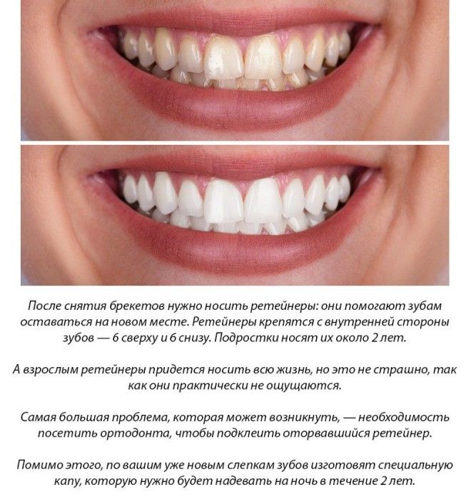 Брекеты и беременность. клинический случай из практики «диал-дент»