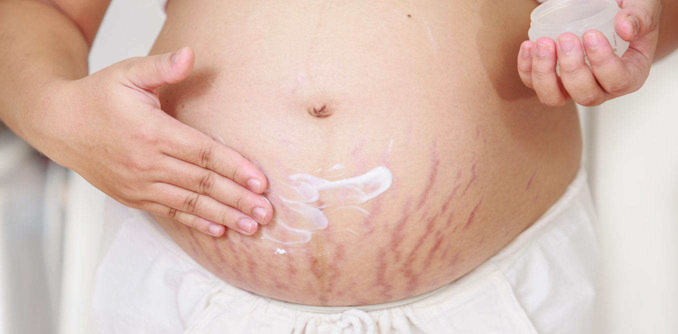 Растяжки во время беременности: причины появления, профилактика и лечение   | материнство - беременность, роды, питание, воспитание