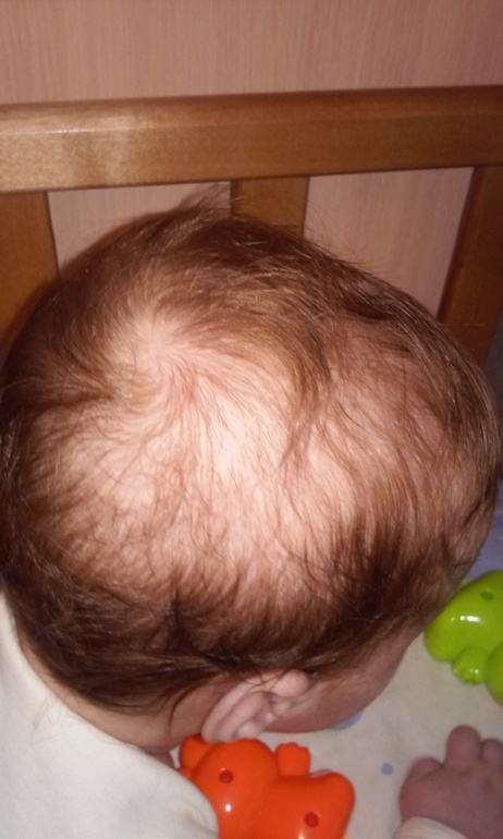У грудничка выпадают волосы на голове: почему это бывает у новорожденных до года