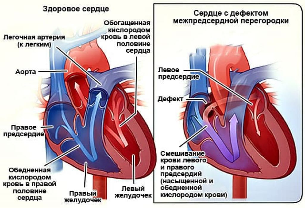 Открытое овальное окно в сердце: у ребенка, новорожденного и взрослого