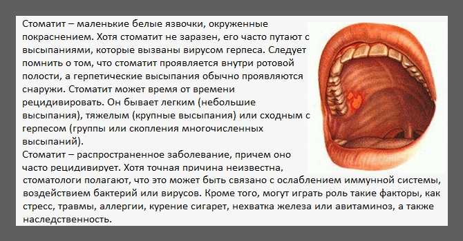 Лечение стоматита у детей
