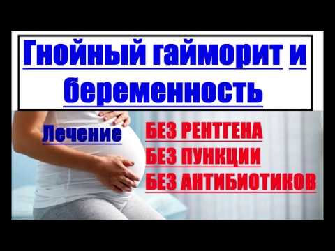 Гайморит - клиника «к+31»