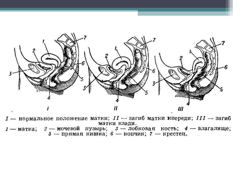 Загиб матки фото крупным