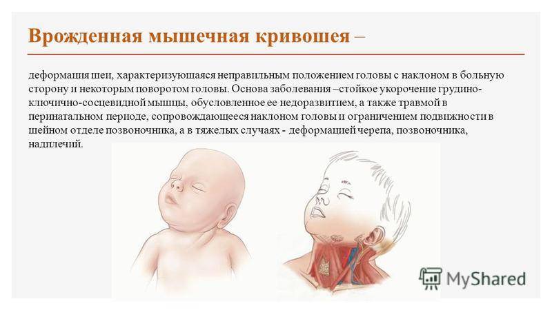 Лечение кривошеи у новорожденных: признаки, как лечить у грудничков в 3 месяца
