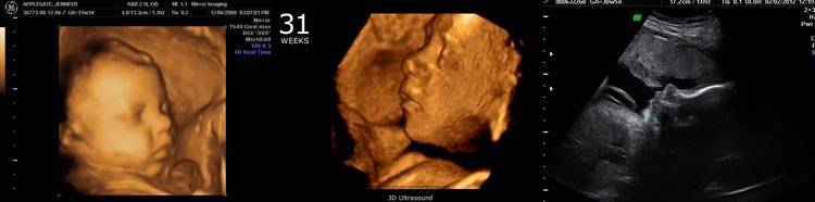 31 неделя беременности развитие и фото — евромедклиник 24