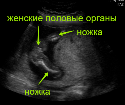 Мальчик 19 недель. УЗИ 19 недель беременности мальчик. УЗИ В 19 недель беременности фото УЗИ. УЗИ 16 недель беременности пол девочка. УЗИ пола ребенка на 19 неделе беременности.