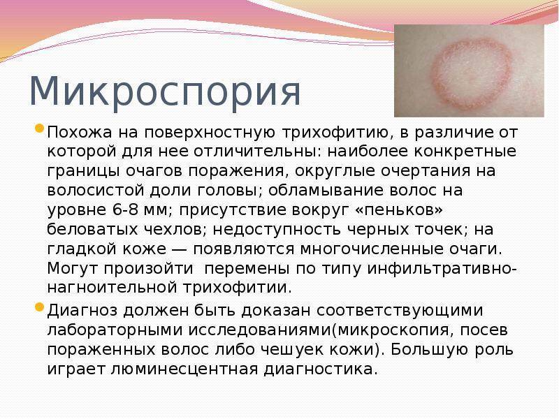 Микроспория кожи: лечение, диагностика