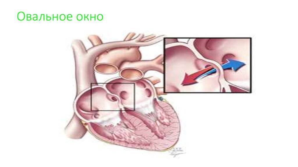 Открытое овальное окно в сердце у детей и взрослых - понятие, причины незакрытия, течение и тактика лечения