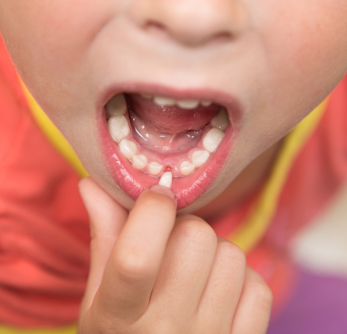 Как удалить молочный зуб ребенку в домашних условиях. шатающиеся зубы у детей