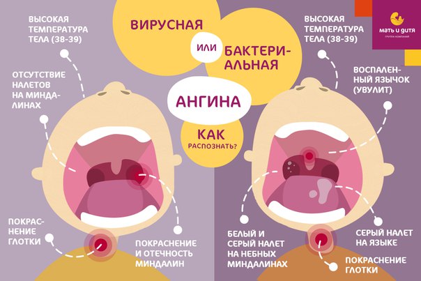 Острый тонзиллит у детей — симптомы и лечение ангины у детей