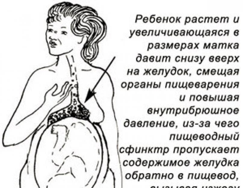Изжога на ранних сроках беременности