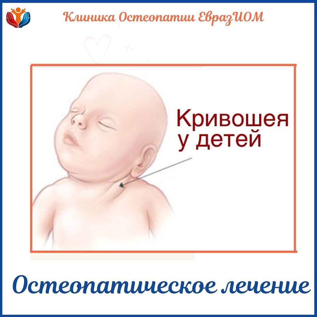 Врожденная мышечная кривошея - симптомы болезни, профилактика и лечение врожденной мышечной кривошеи, причины заболевания и его диагностика на eurolab