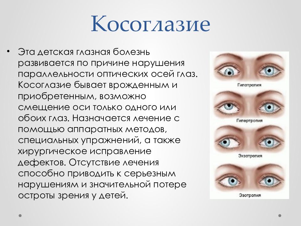 Презентация на тему косоглазие