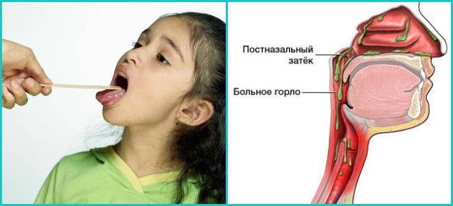 Cтекание слизи по задней стенке глотки