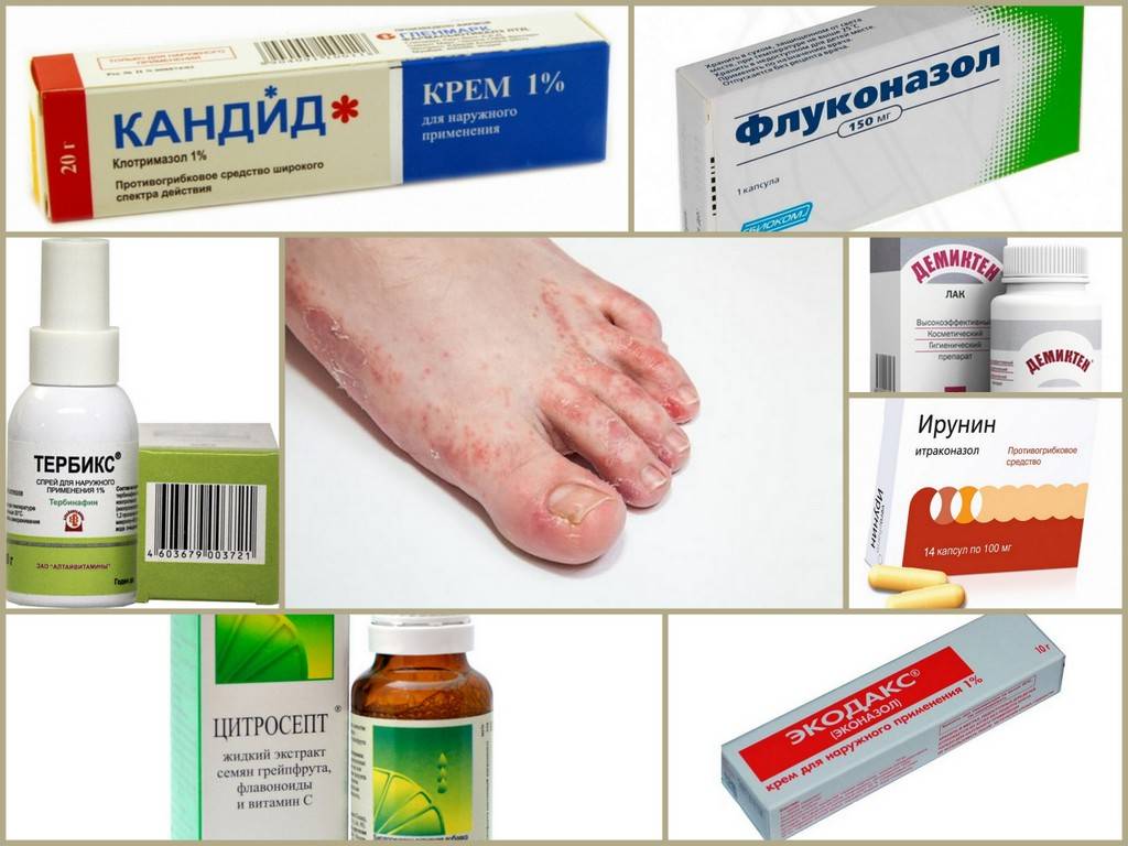 Противогрибковые препараты (антимикотики) – виды и различия